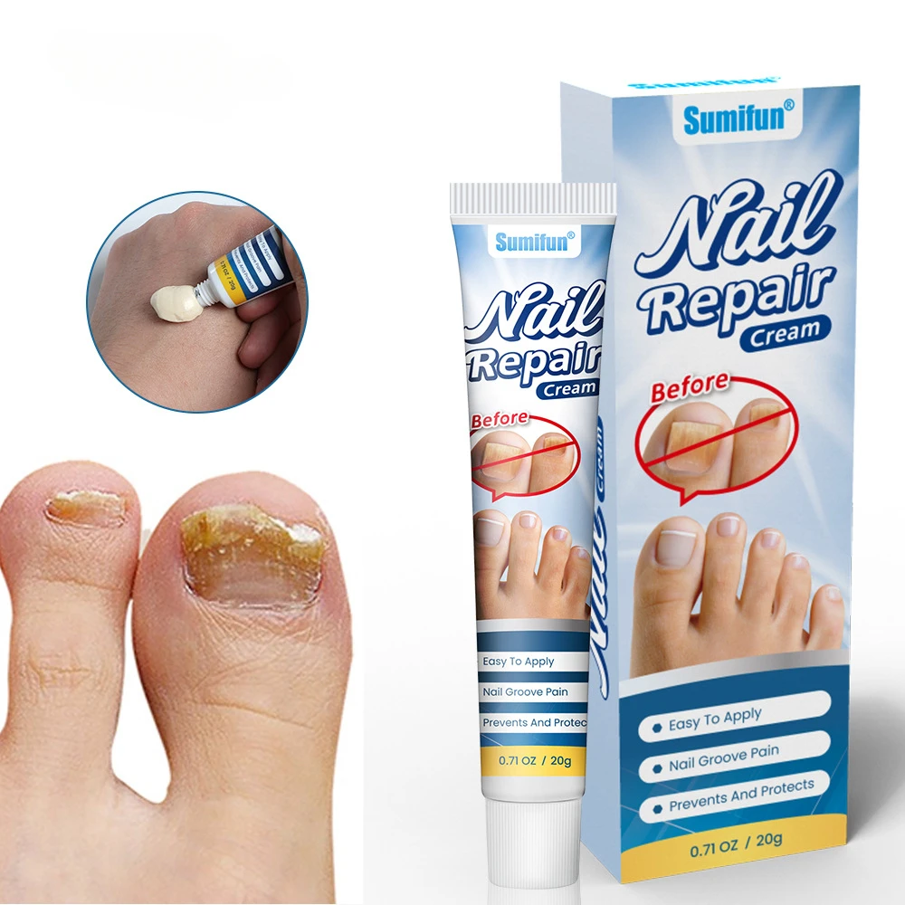 Nail Fungus Treatment Cream Foot Toe Nail Fungus Removal Serum Anti-infection Paronychia Onychomycosis Repair Gel Care U&ntilde;as