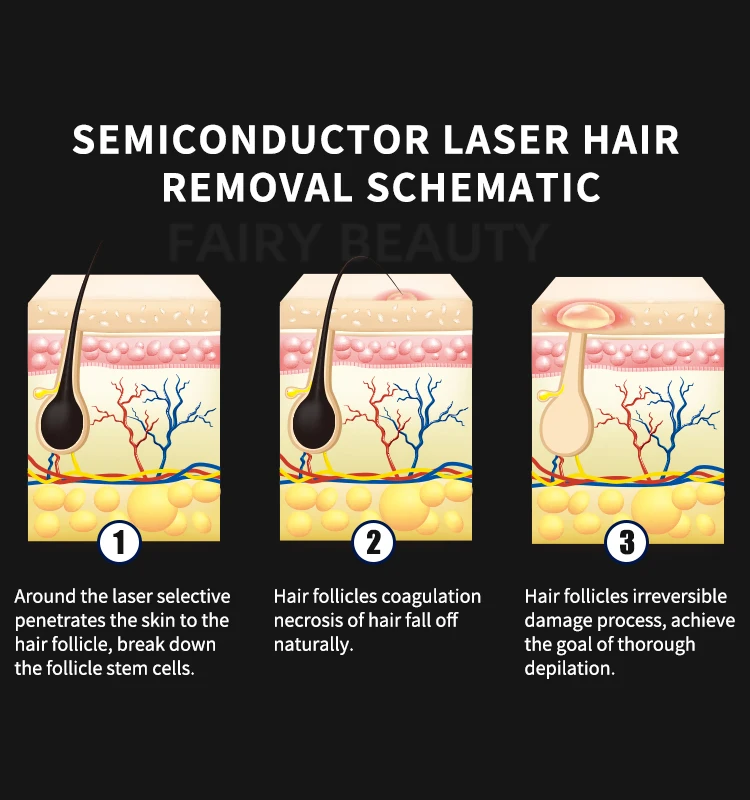 Hochleistungs-3-Wellenlänge 755 808 1064 Laser-Haarentfernungs-Epiliergerät 808 nm Diodenlaser-Haarentfernungsgerät für den Salongebrauch – Detail 6