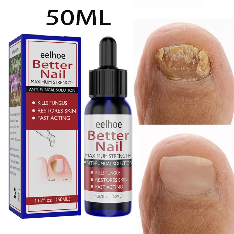 50MLRingwormOfNailsRepairLiquidFungusTreatmentRepairNail