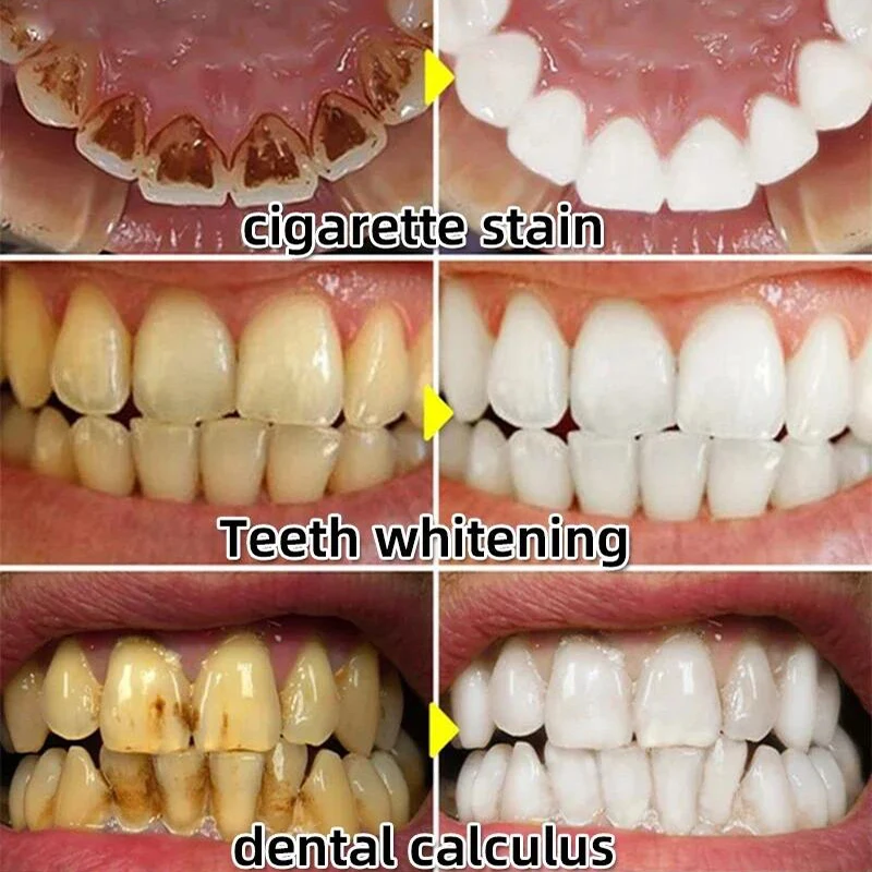 Dental Calculus Remover Teeth Whitening Spray Toothpaste Cleaning Oral Hygiene Removal Halitosis Plaque Stains Fresh Breath Care dental calculus remover