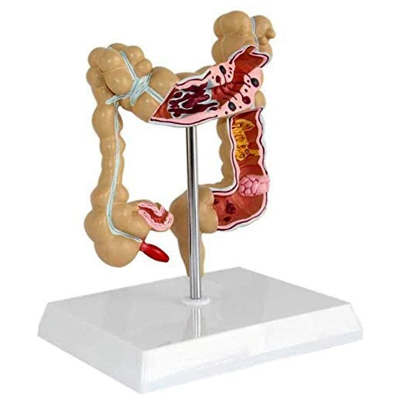 

Модель большого желудочно-кишечного рака модели патологического колоректального рака