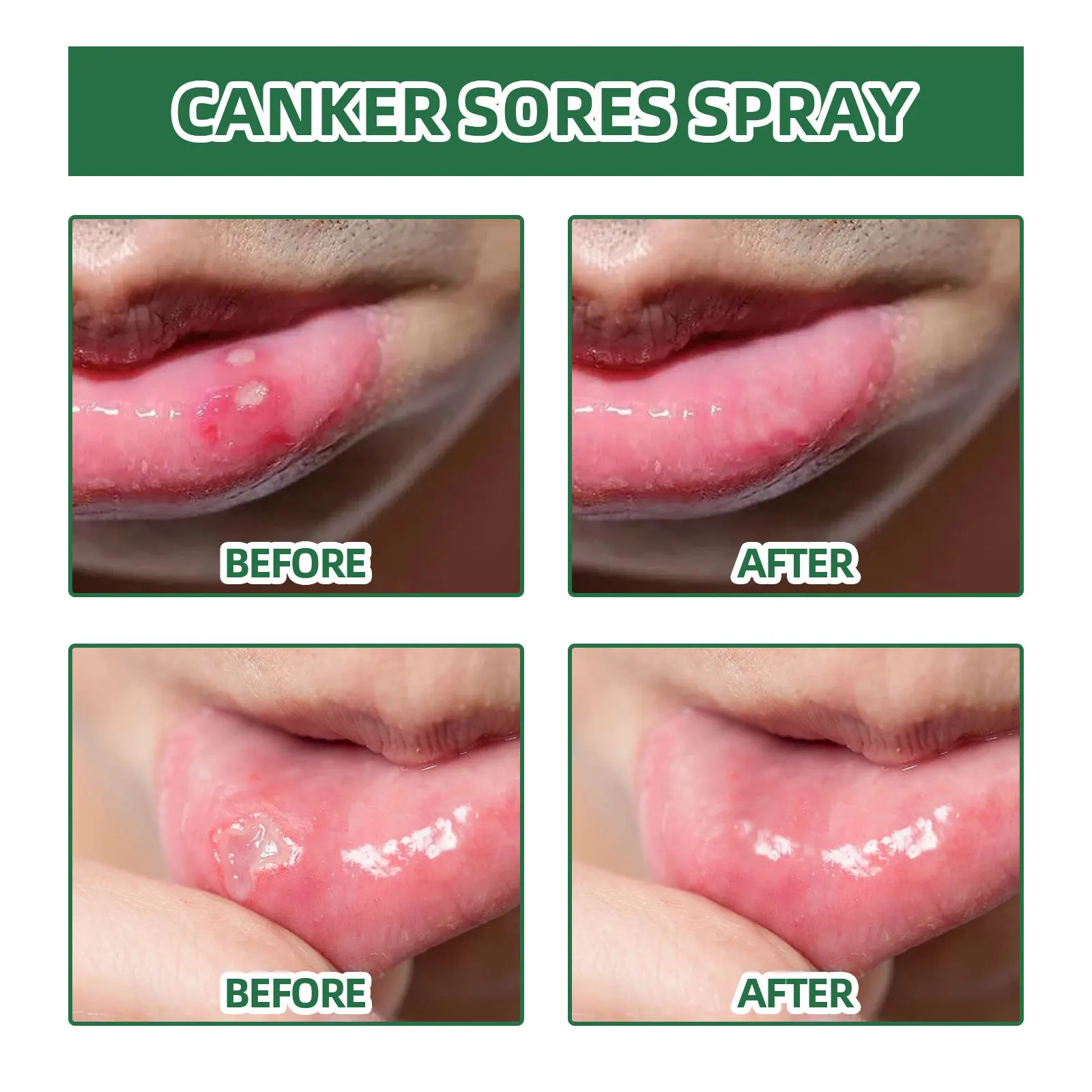 Oral Ulcer Spray 20ml herbal oral spray Canker Sores Swelling in The Gum Fresh Breath and Mouth Ulcer Care Spray Belleza Y Salud Oral Care