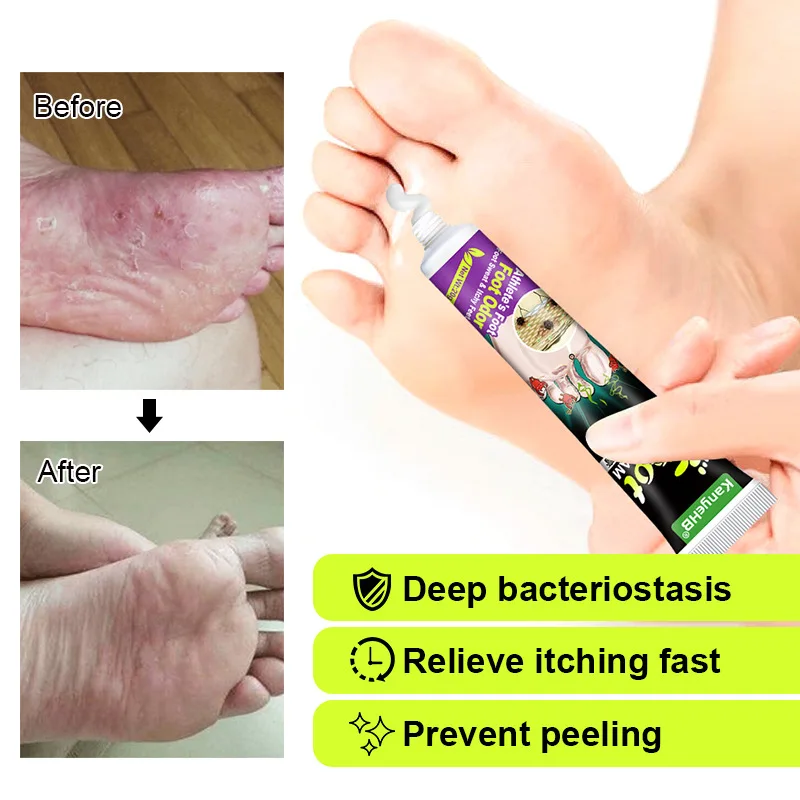 Personal Health Care Pain Analgesic Cream 20g Beriberi Treatment Anti Fungal Infections Foot Cream Anti-itch Athlete Relief Itch Erosion Peeling Blisters Medical Plaste