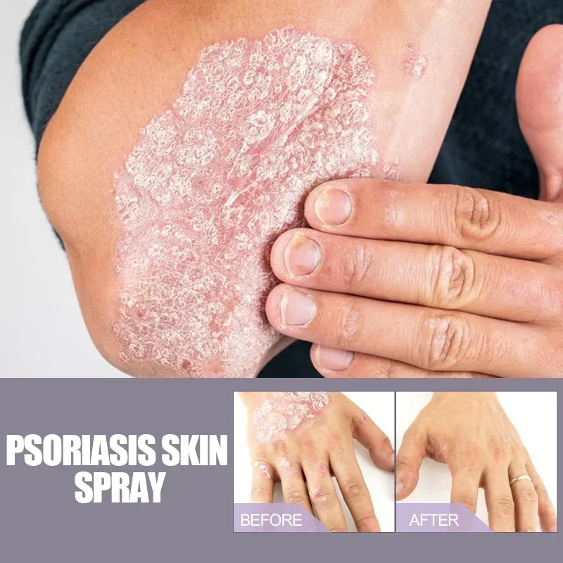 Hand Tinea Foot Odor beriberi spray Eczema Psoriasis Treatment Dermatitis Fungus Removal Relief itch deodorant skin repair care