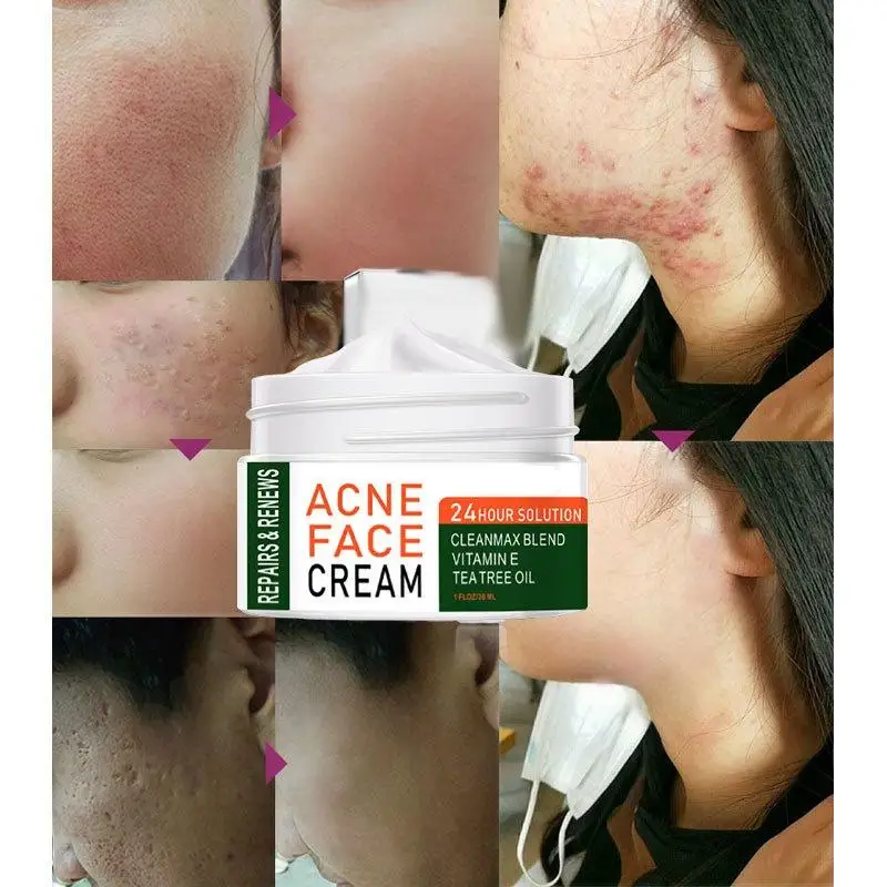 

Herbal Tea Tree Oil Anti Acne Face Back Acne Scar Removal Cream