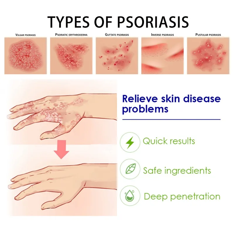 Psoriasis Ointment Anti-Itching Skin Repair Problems Treatment Eczema Dermatitis Antifungal Topical Body Care Essence Ointment