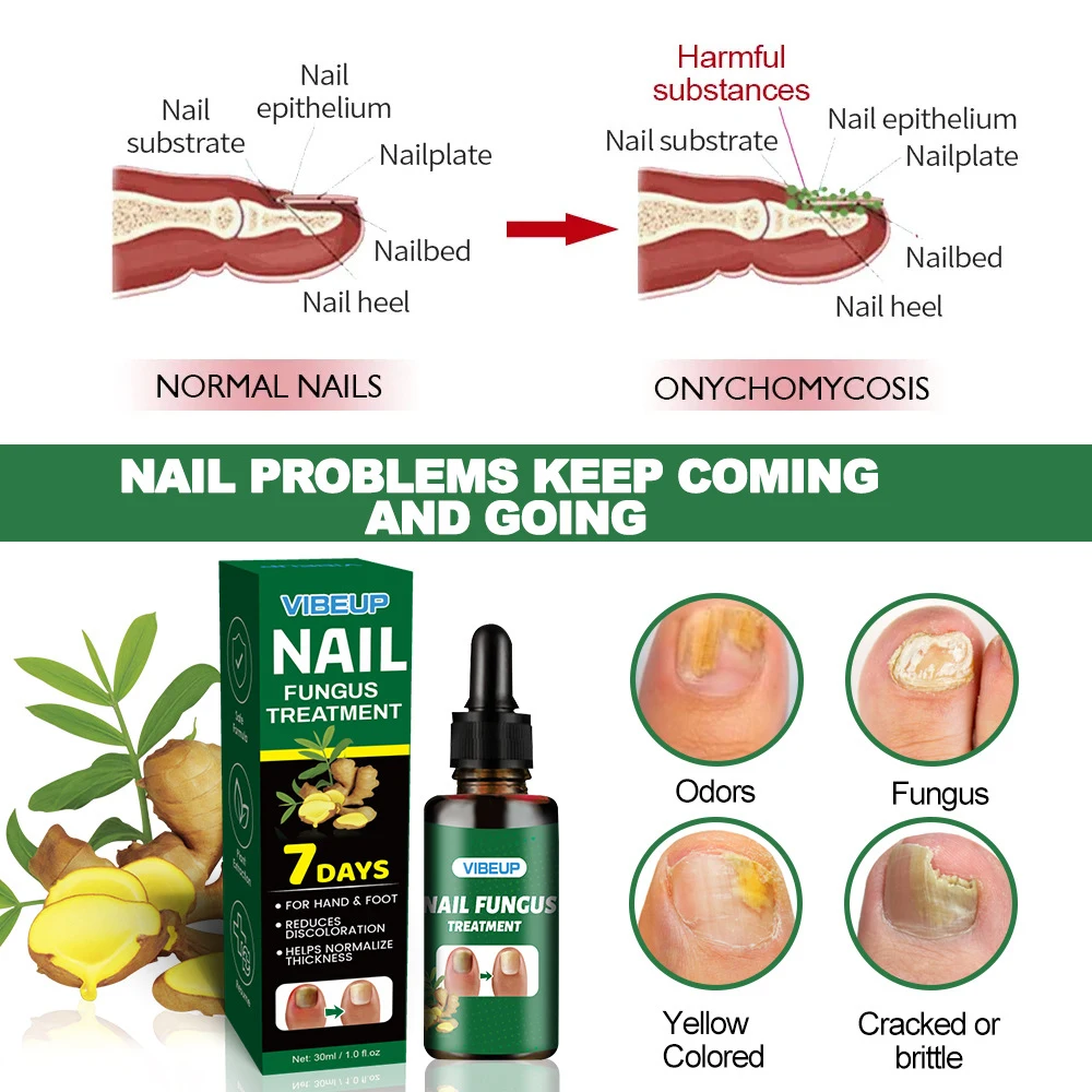 Fungal Nail Treatment Serum 7 Days Foot Nail Fungus Removal Repair Gel Anti Infection Paronychia Onychomycosis Foot Nails Care