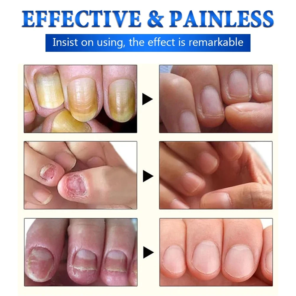 Jemeesen Nail Fungus Treatment Gel Foot Care