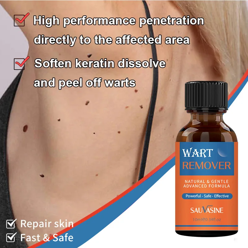 

10ML Fast-Acting Remover Foot Corn Skin Tag Genital Skin Tag Remover Treatment Papillomas Warts Remover Liquid Skin Care
