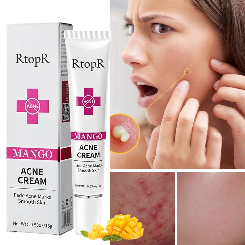 

Acne Removal Whitening Cream Effective Fade Acne Dark Spots Oil Control Anti-Acne Facial Treatment Shrink Pores Beauty Health