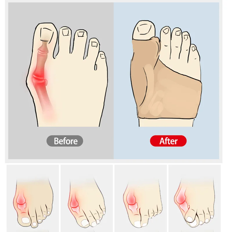 Toe separators bunion corrector halux valgus corrector for women