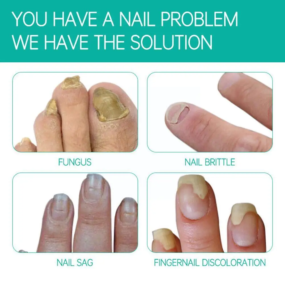 Myclinic - Finger Infection(Paranochia) Finger infections often start when  bacteria, a virus, or a fungus enter the finger through a bite, cut, or  wound. Biting nails or hangnails, thumb-sucking, wearing artificial nails,
