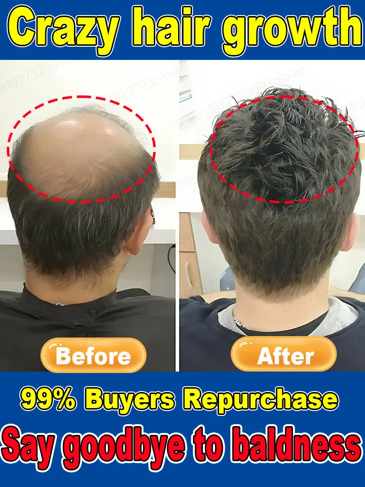 Hot selling product, 99% of buyers repurchase, more hair, say goodbye to baldness, thicker hair