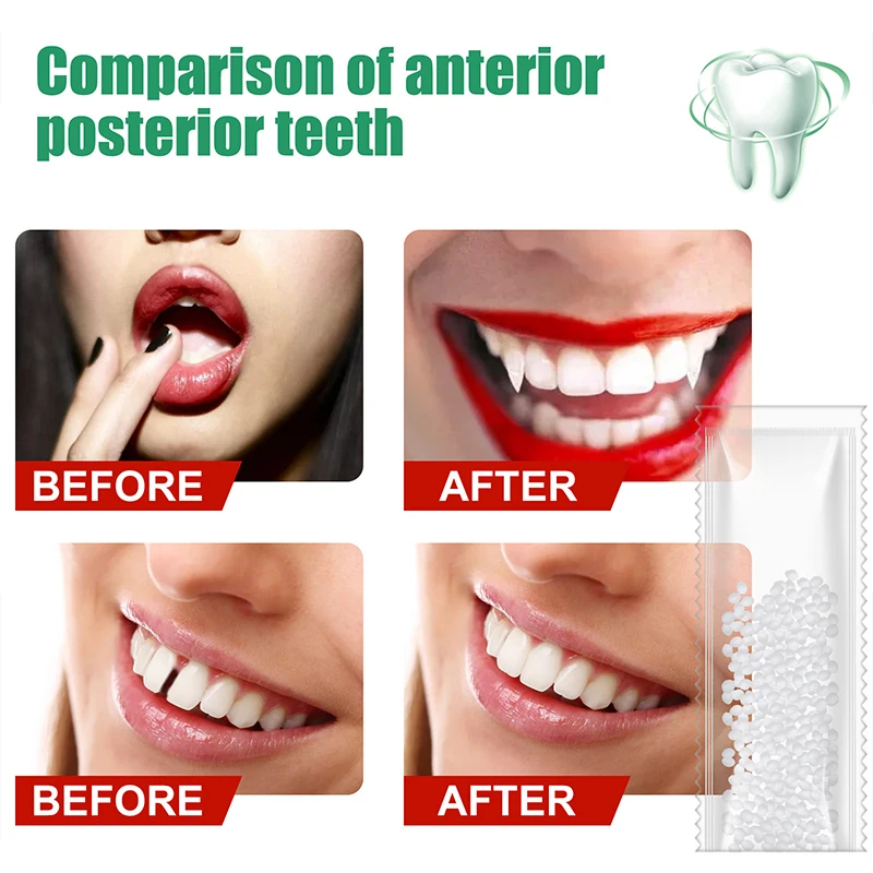 10g Temporary Tooth Repair Kit White Fake Teeth Veneer Thermal Beads  Adhesive Beads - Denture Care Products - AliExpress