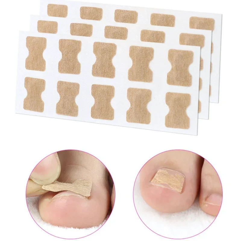 Nail Correction Stickers Ingrown Toenail Corrector Patches Paronychia Treatment Recover Corrector Pedicure Tools 20/50/100pcs ingrown toenail correction tool
