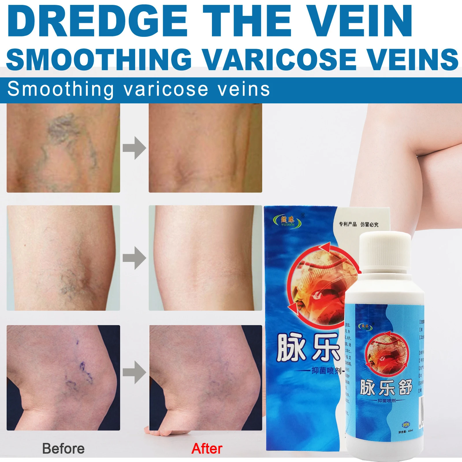 

60ML Varicose Vein Spray Portable Veins Dressing Professional Earthworm Leg Treatment Supplies Vein Phlebitis Soothing Solution