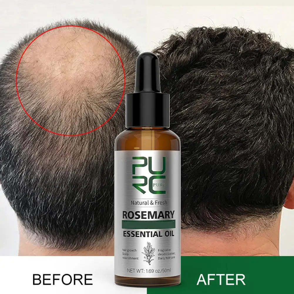 Description Picture 6 of item1/3/5Pcs Rosemary Oil Hair Growth For Men Women Fast Growing Essential Oils Ginger Anti Hair Loss Scalp Treatment Hair Care