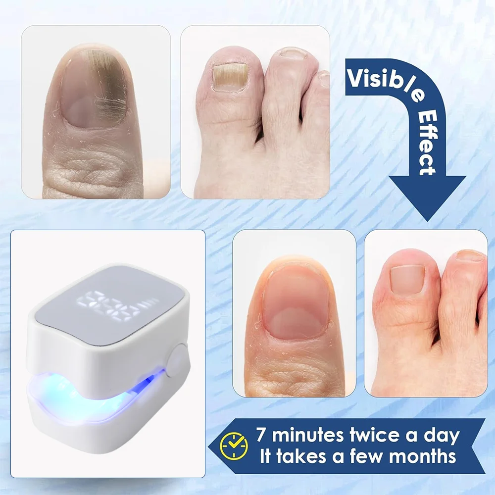 Nail Fungus Remover JUSTLANG Rechargeable Fungus Grey Nail Treatment Device Portable Onychomycosis Treatment Laser Therapy Relieve Ingrown Foot Care