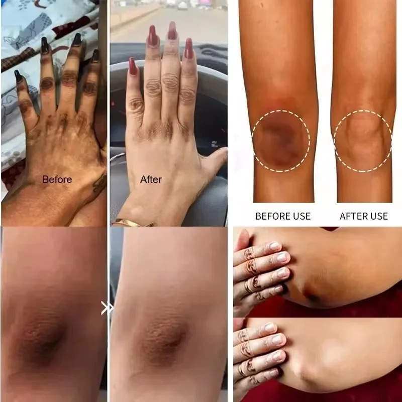 Nicotinamide Brightening Cream For Dark Skin Effective Lighten Thigh Inner Bleach Remove Melanin Private Parts Brighten Cream 2