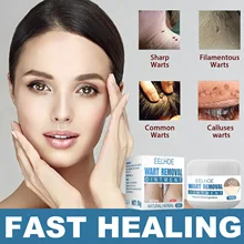 

EELHOE 30g Instant Blemish Removal Gel Wart Removal Cream Remove Common Skin Tag Body And Foot Care Cream Skin Tag Remover