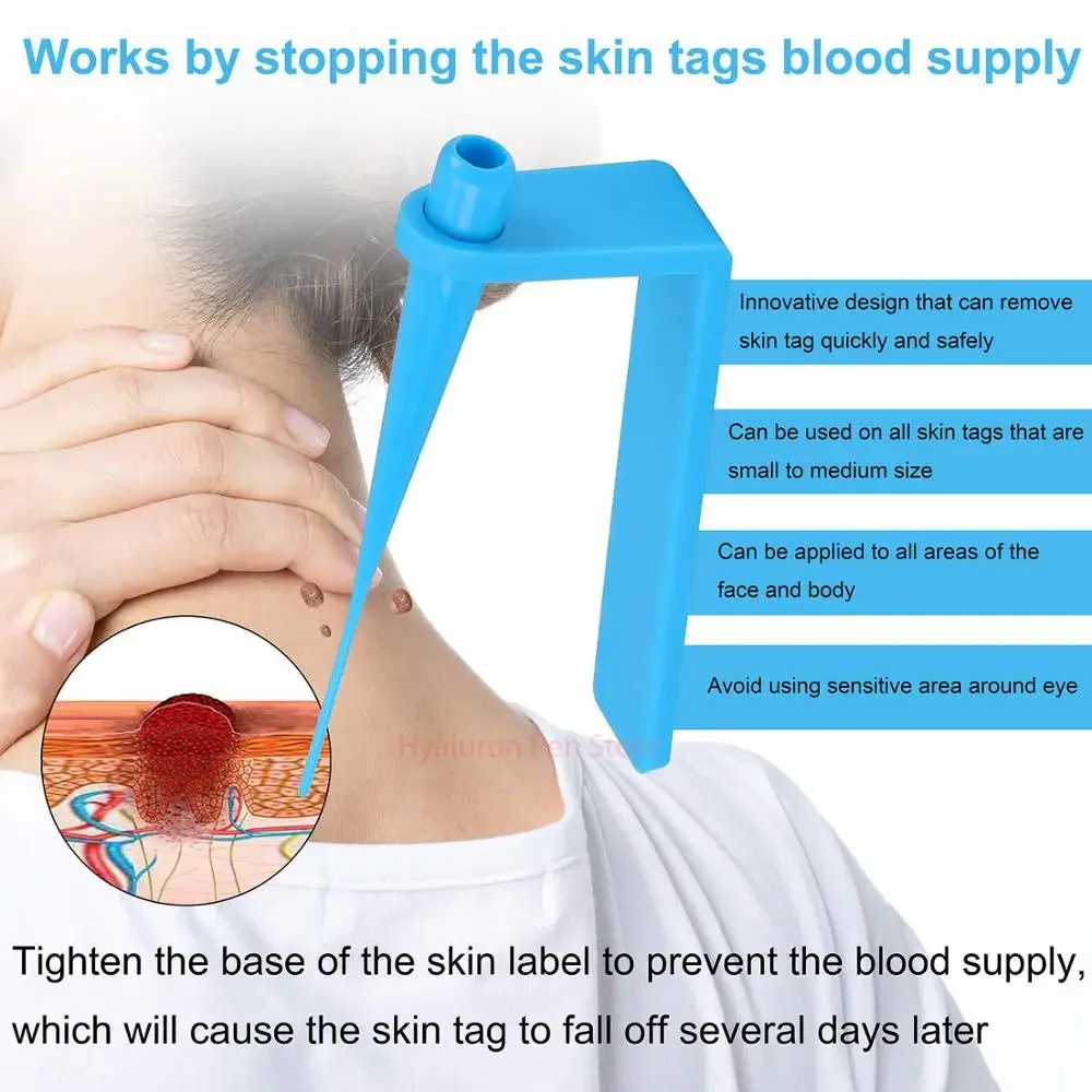 Skin Tag Removal Kit Papilloma Removal Skin Cleansing Band Kit For Remove Berrugas Wart Dots Mole Beauty Appliances