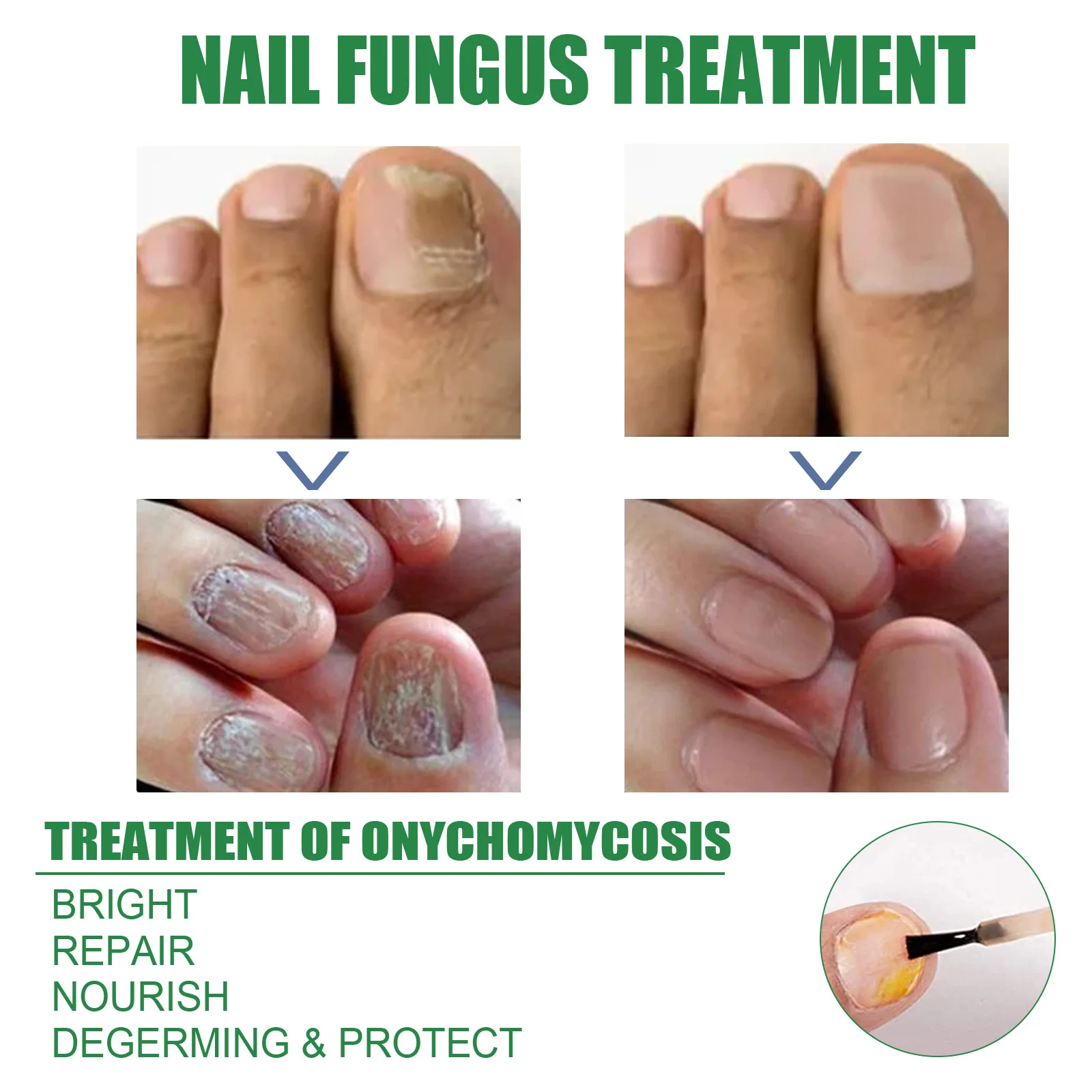Fungal Nail Treatment Tea Tree Essence Oil Nail Fungus Repair Toenail Fingernail Ginger Treatment Hand Foot essence Liquid