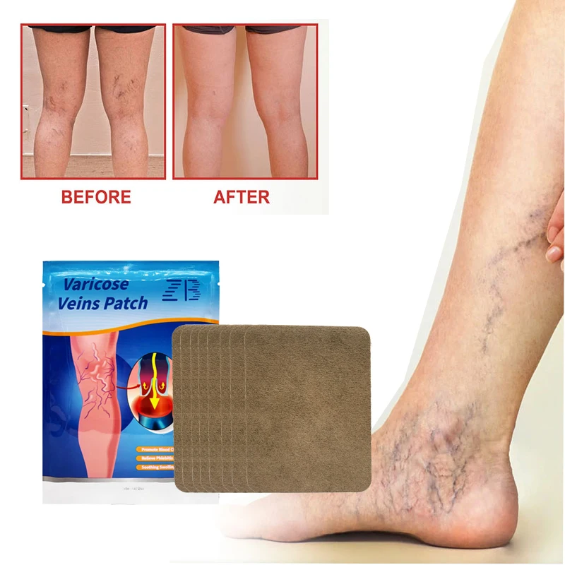 

6/8/12Pcs ZB Varicose Veins Ointmnet Vasculitis Phlebitis Spider Cream Varicosity Angiitis Removal Herbal Medical Plaster