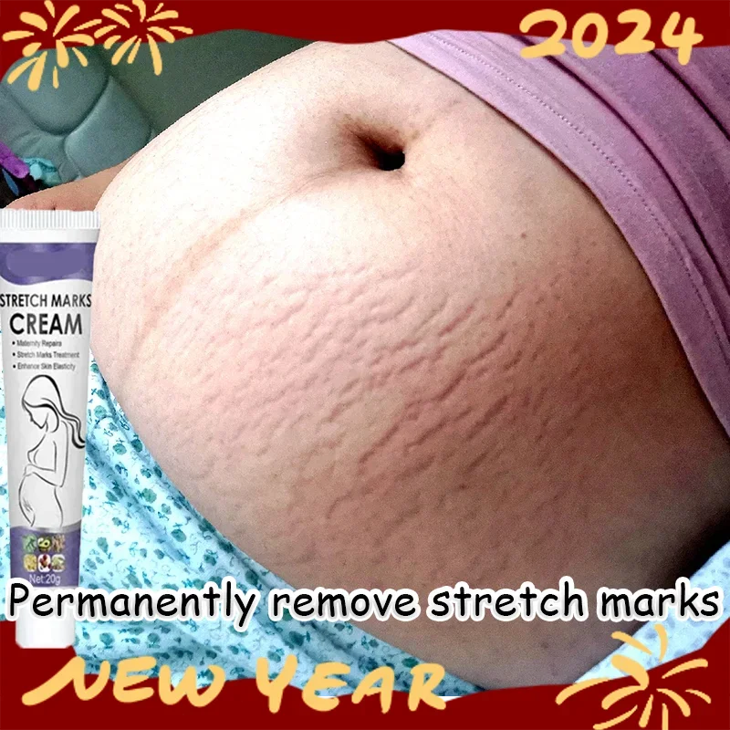 Stretch Mark Removal Cream Permanently Removes Stretch Marks Rejuvenates Skin Mark Removal Cream