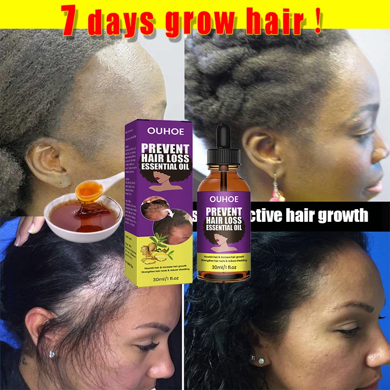 Anti Alopecia Oil Hair Growth Essential Oils For Black Women Essence