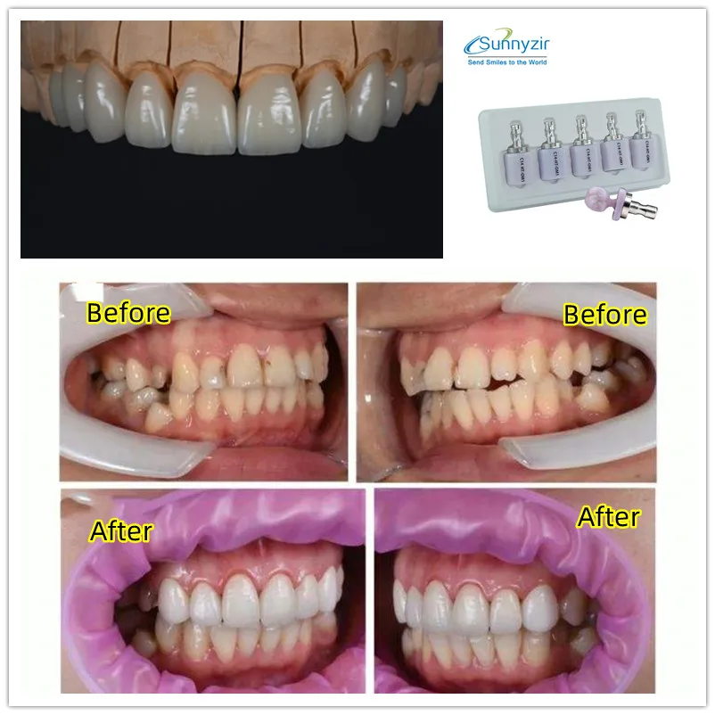 

Sunnyzir 5pcs Lithium Disilicate C14 Glass Ceramic Blocks LT Dental Lab Material for CAD CAM Sirona Cerec Milling System