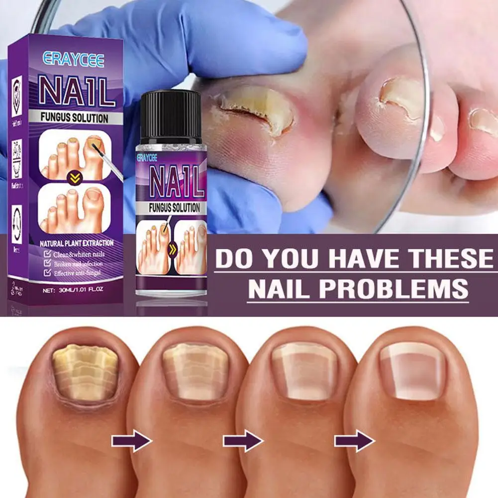 

Nail Repair Essence Nail & Toenail Fungal Solution 30ml Toenail Treatment Drops Extra Strength Nail Repair Solution