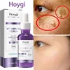 Powerful Dark Spots Remover Whitening Serum Face Freckle Melanin Correcting Anti Pigmentation Brighten Skin Beauty Care Essence 1