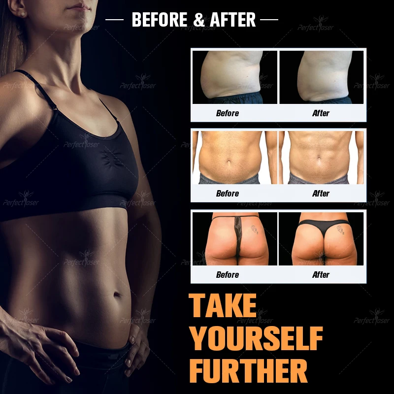 Рисунок 6 - Аппарат Perfectlaser для стимуляции мышц и похудения