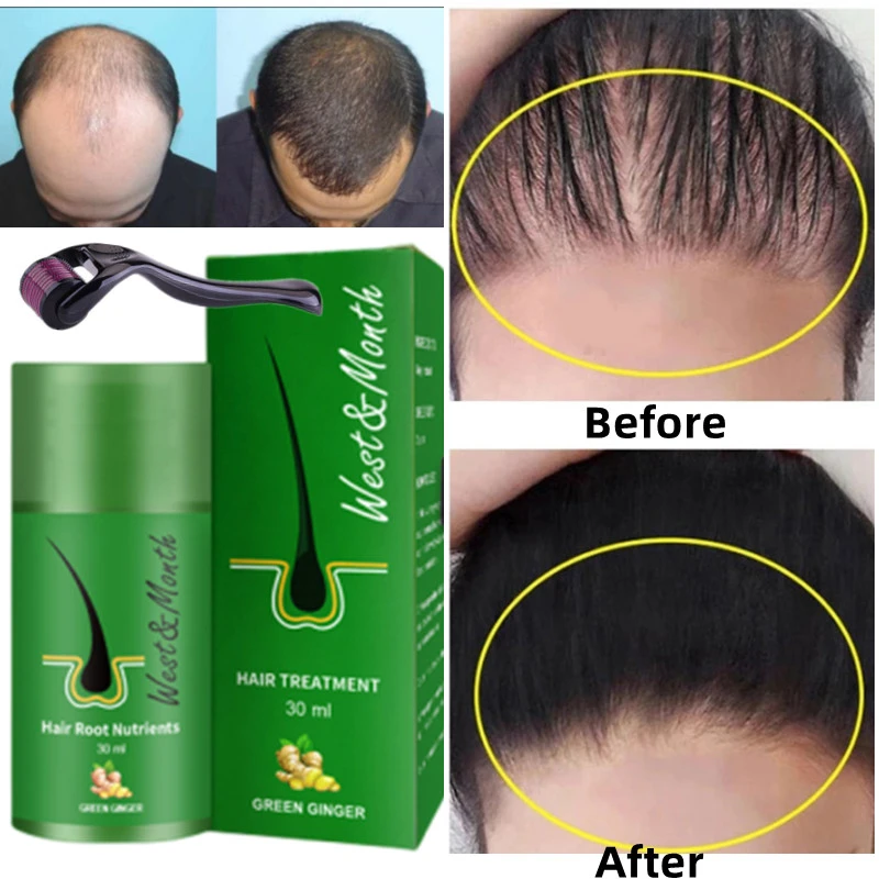 Ginger Hair Growth Spray Essential Oils Hair Loss Treatment Fast Grow  Prevent Hair Dry Frizzy Damaged Thinning Repair Care 30ml - Hair Loss  Product Series - AliExpress