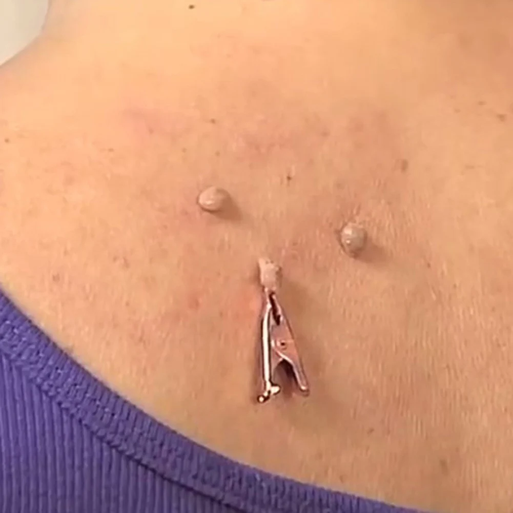 Painless Skin Tag Mole Wart Spot Removal Clips Body Warts Treatment Safe Foot Corn Removal Skin Care Clips Home Use