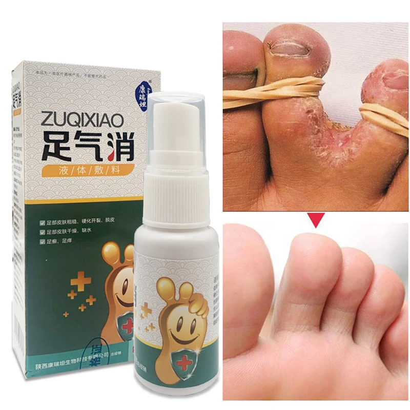 Anti Fungal Spray Foot Fungal Spray Relieve Beriberi Toe Treatment Plaster for Cracked Heel