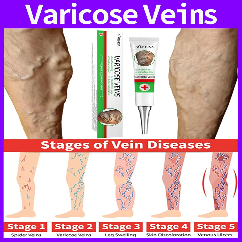 Varicose Vein Removal Cream Best Products to Fight Varicose Veins Natural Plant Extracts to Treat Varicose Veins 50g spider leg gel effective convenient plant extracts varicose vein repair cream for postpartum obese people