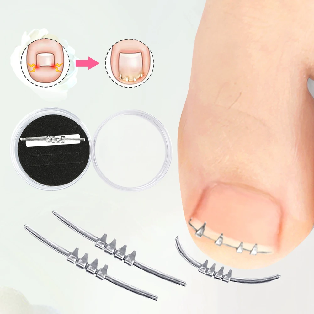 Ingrown Toenail Correction Foot Care Tool Straightening Correction Clip Curved Clamp Toenails Correction Tool for Toes