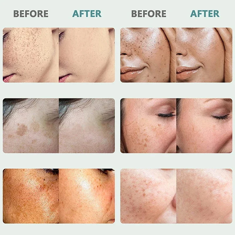 Face Brightening Cream Niacinamide Reduce Melasma Melanin Lighten Dark Skin Chloasma Serum Weaken Fine Lines Care niacinamide serum whitening body cream