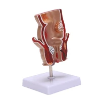Anatomy Model Human Rectal Hemorrhoid Lesion Model Hemorrhoid Fistula Fistula Fissure Pathology Teaching Model 1