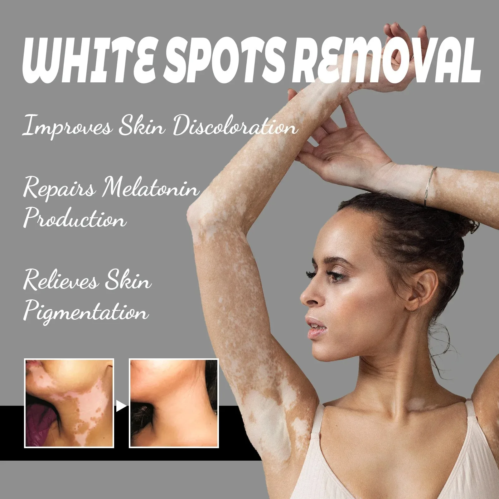 Spray anti-Vitiligo, élimine les taches blanches de la teigne, élimine les taches de sueur, traitement de la leucoplasie, répare, hydrate la peau, liquide de soin_voghion.com