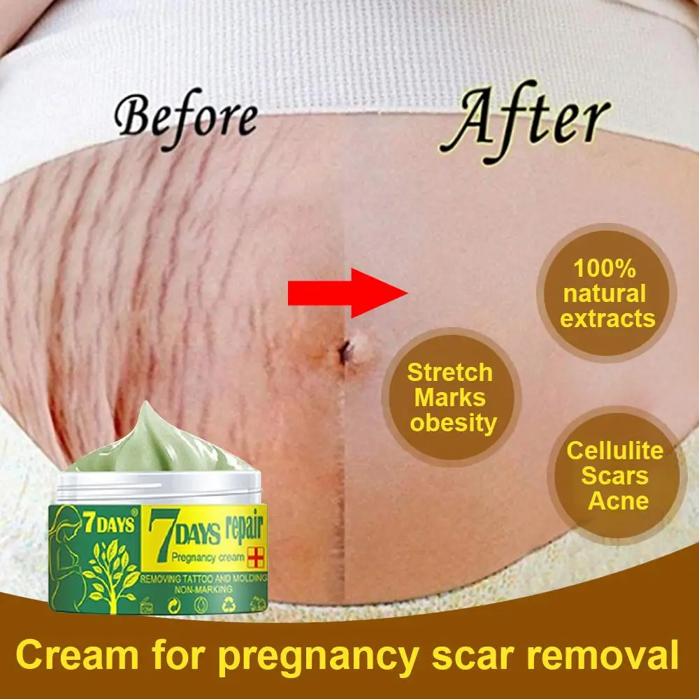 Tanie 7DAY Pregnancy Repair Cream To Effective Remove Stretch Marks Scarring Emulsion Stretch Marks Treatment