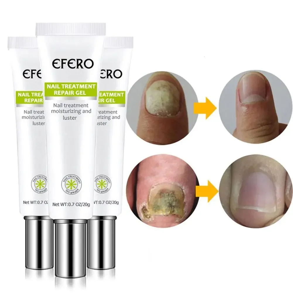 EFERO Fungal Nail Serum Repair Essence Foot Nail Fungus Removal Gel Anti Infection Paronychia Onychomycosis Treatment 2PCS toenail fungus patch,anti fungal cream