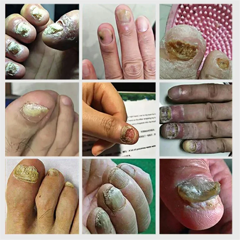 Fungal nail treatment serum foot nail fungus removal repair gel anti infection paronychia onychomycosis foot nails care essence