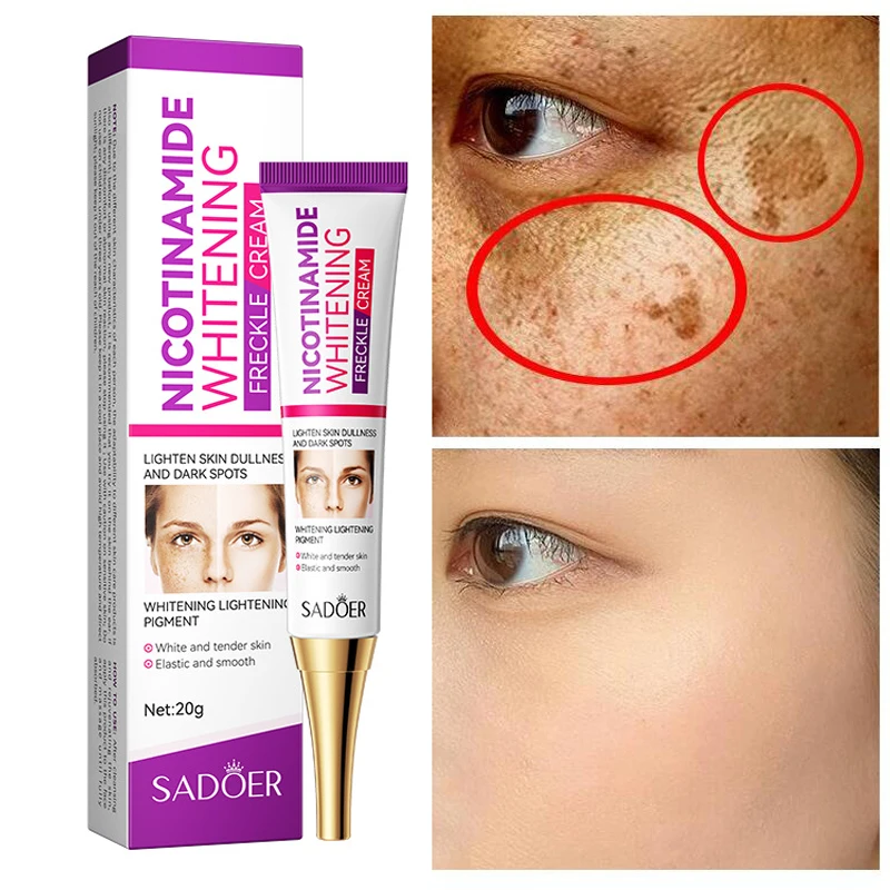 Gel Smooth Face Skin Care Anti Freckle Whitening Cream Lightening Blemish Removal Reduces Age Spots Freckles 10 days freckles removal day