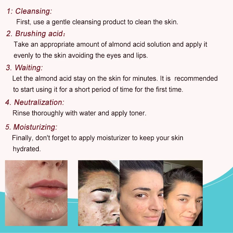 Face Chemical Peeling Mandelic Acid 18% almond acid VMA peeling peel face chemical peeling Strong