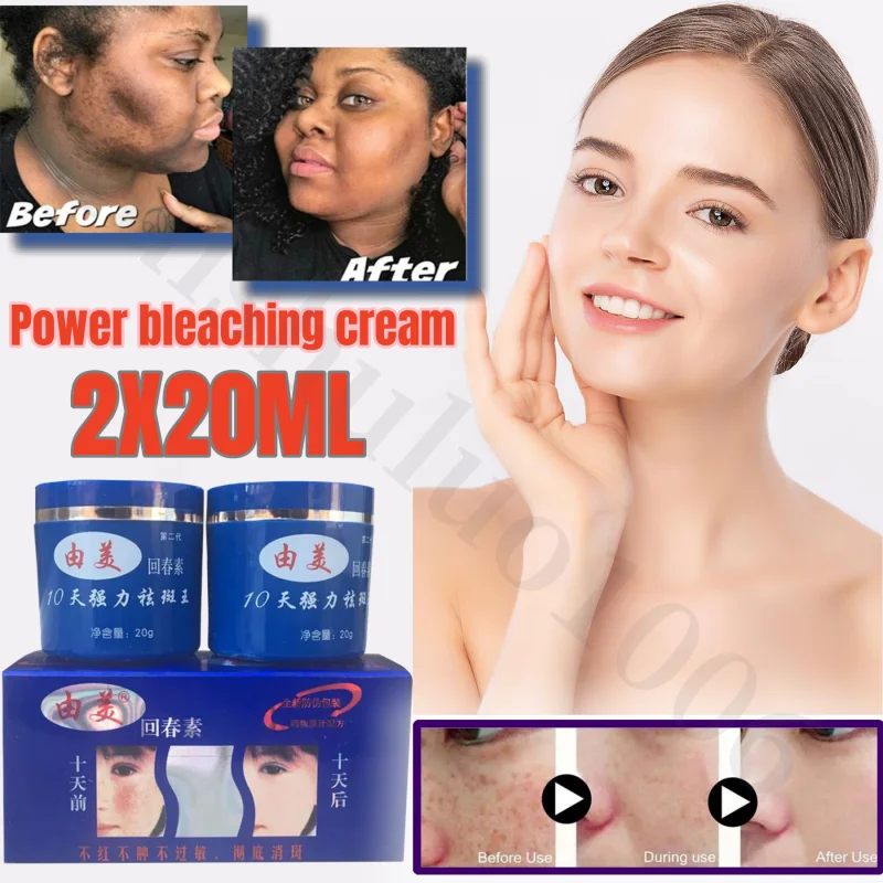 10 DAYS Freckles Removal Day & Night Cream Remove Dark Spots Pigment Whitening and Brightening Skin Care пигмент хайлайтер для лица pigment skin haghlighter pbl 1272 03 03 8 5 г