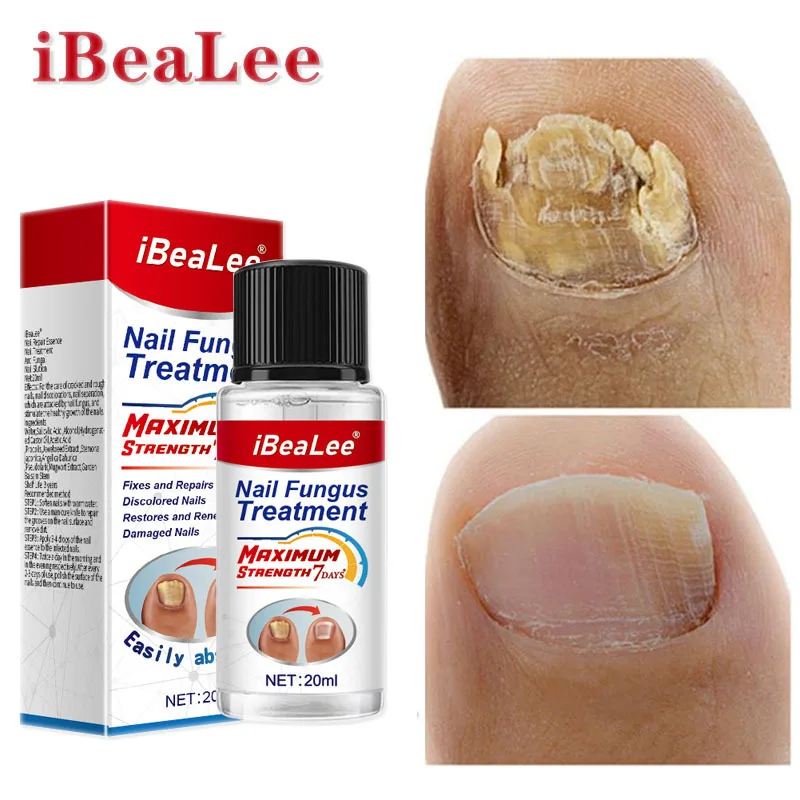 

7DAYS Fungus Nail Treatment Serum Anti Infection Onychomycosis Paronychia Removal Toe Hand Foot Fungal Repair Products Feet Care