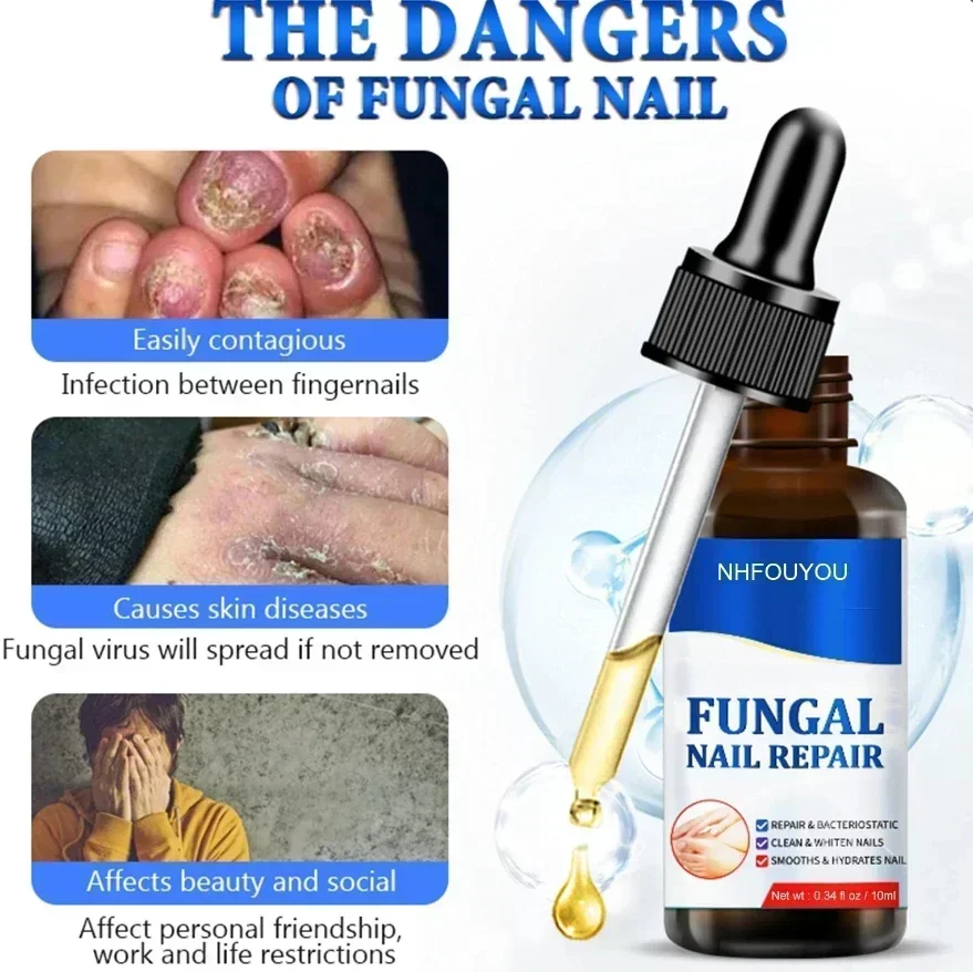 Toenail Nail Fungus Treatment Device for Foot Nail Fungus Essential Oil Onychomycosis Care nail fungus treatment