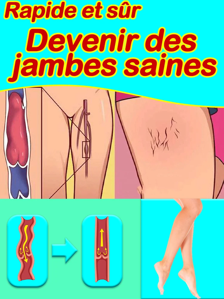 

varicose